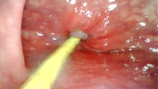 EXTREME ANAL POINT OF VIEW. ONLINE CAM INSIDE HER BUTT-HOLE AS I POUND HER WITH MY GIANT WANG AND SPERM DEEP INSIDE